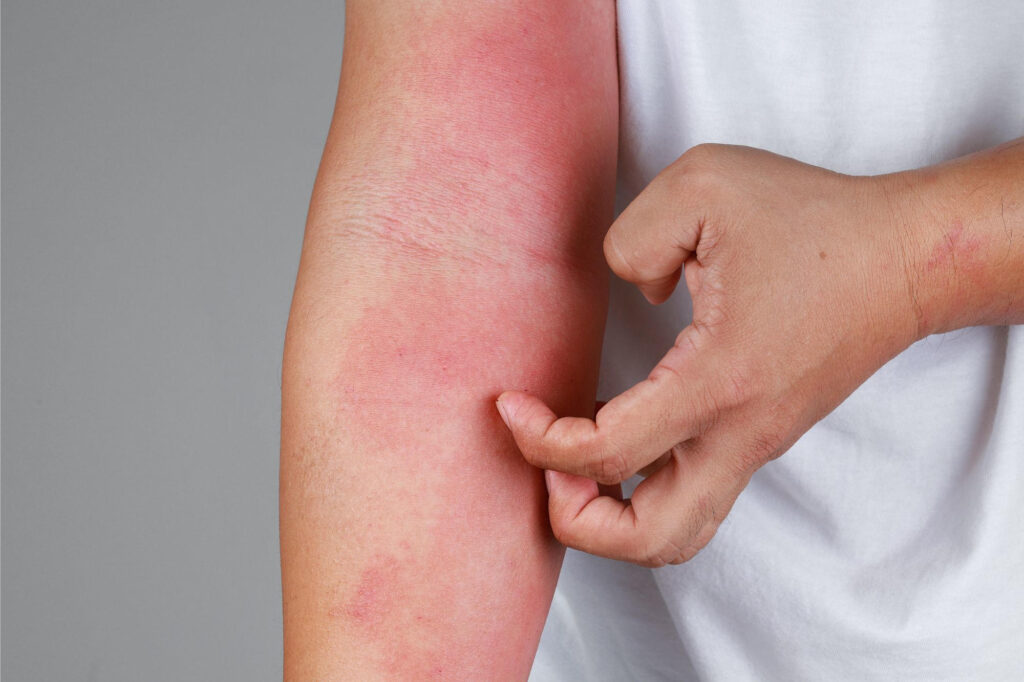 New Method Prevents Allergic Reactions Without Causing Side Effects