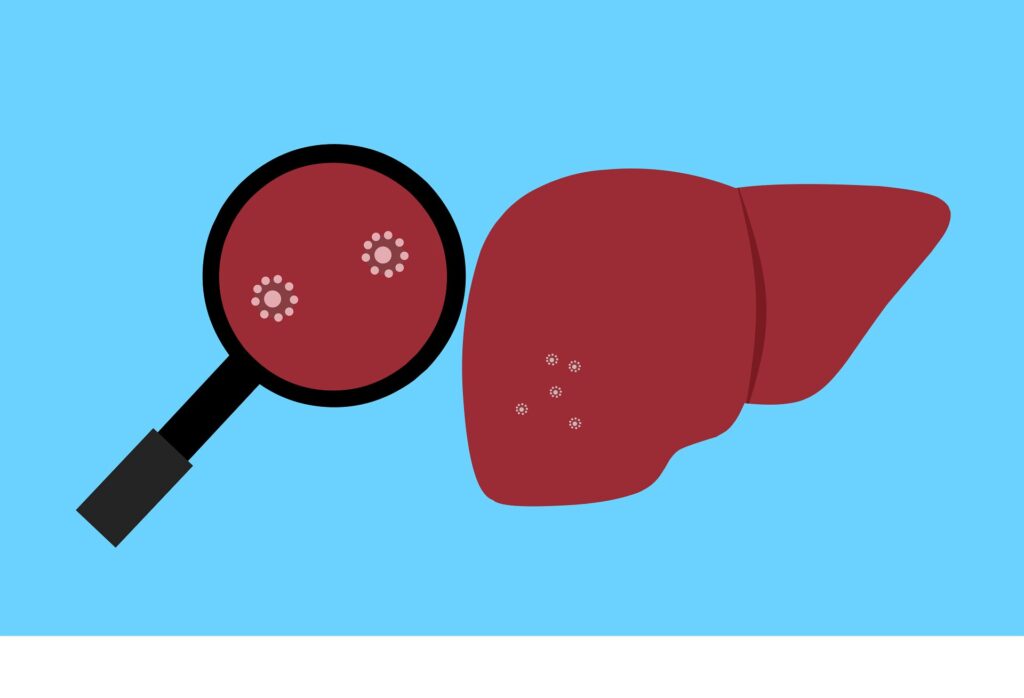 Treating liver cancer with microrobots piloted by a magnetic field