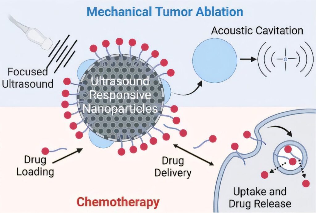 Drug-loaded nanoparticles can enhance precision and safety of ultrasound tumor treatment