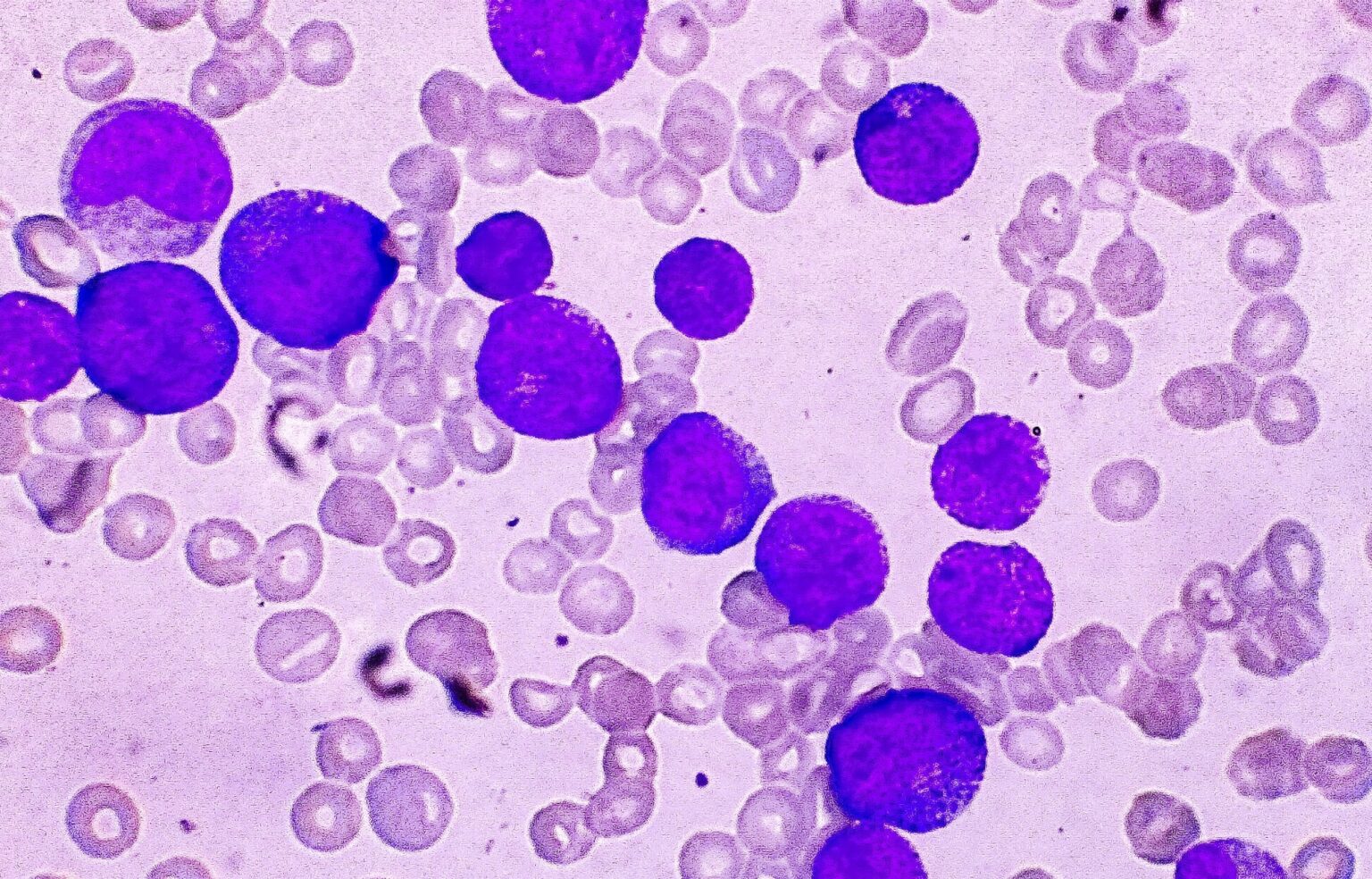 New Therapy Uses Tumor Chemistry to Trigger Cancer Cell Death